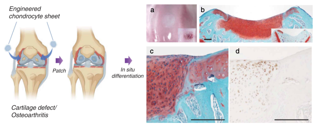 Graphic: Engineered Human Juvenile Chondrocyte Sheets Safely Repair Damaged Cartilage